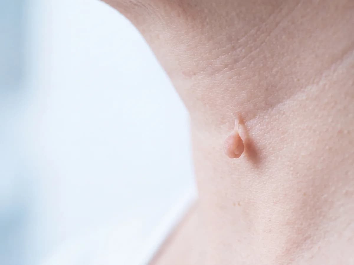 Retrait d'acrochordons (molluscum pendulum) — photographie d'illustration