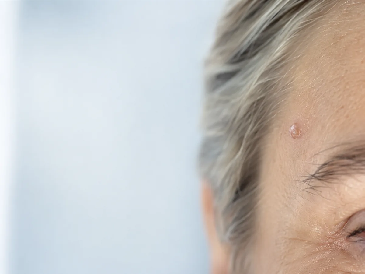 Chirurgie du carcinome cutané — photographie d'illustration