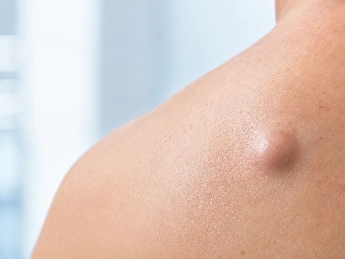 Chirurgie du kyste épidermique — photographie d'illustration