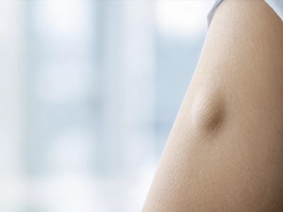Chirurgie du lipome — photographie d'illustration
