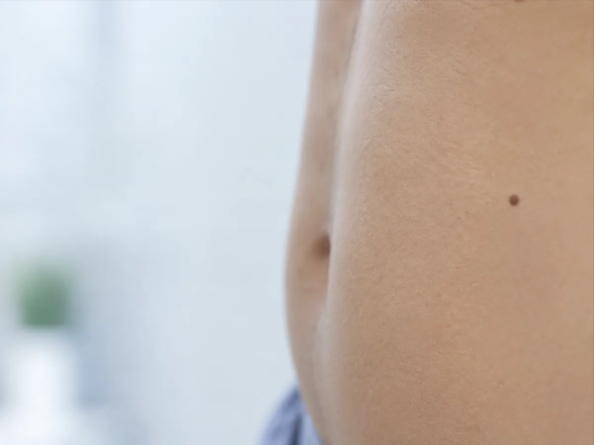 Chirurgie du nævus (grain de beauté) — photographie d'illustration