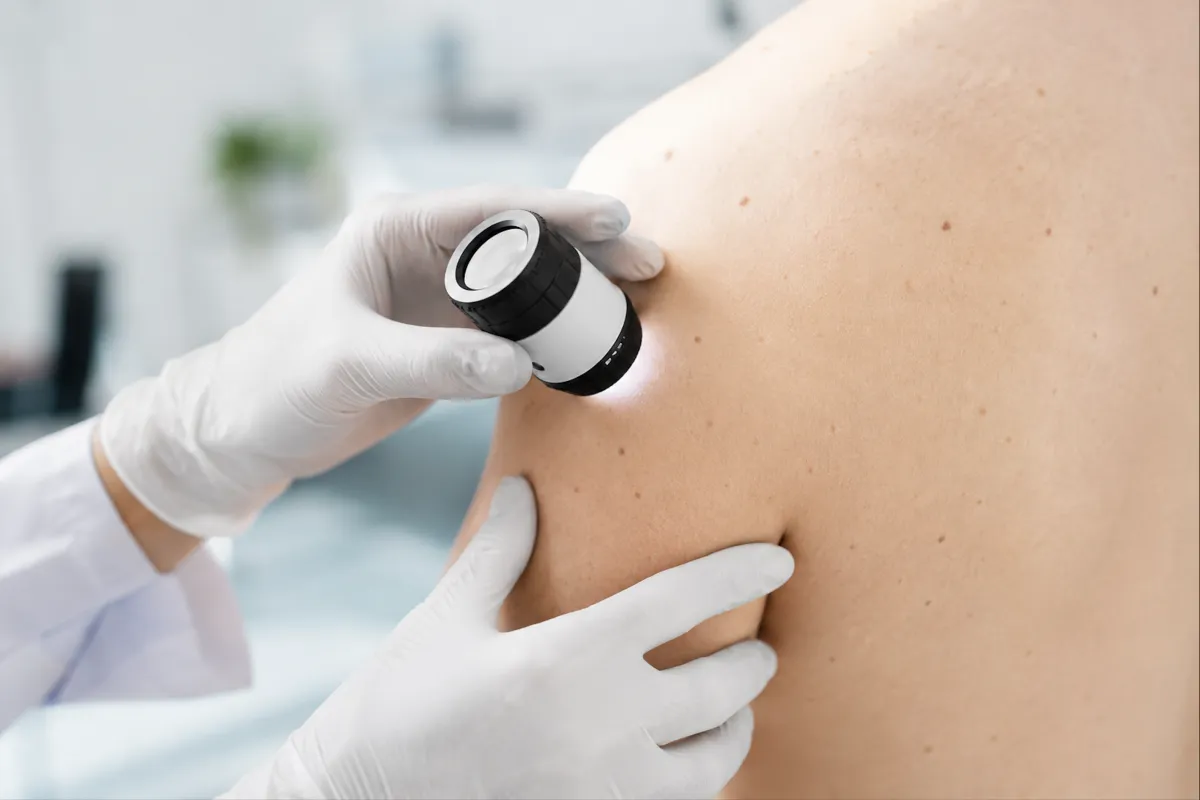 Mélanome : les signes qui doivent alerter et l'importance du dépistage précoce