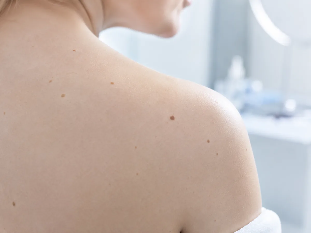 Surveiller ses grains de beauté : repères et bons réflexes
